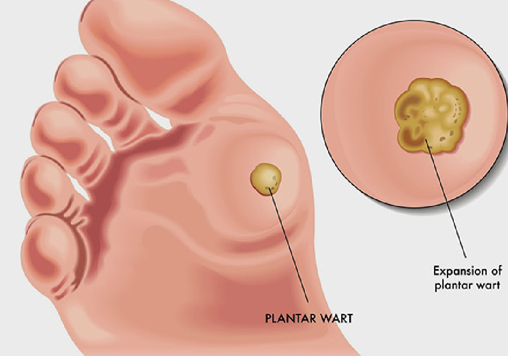 Corn and Wart Treatment in pune